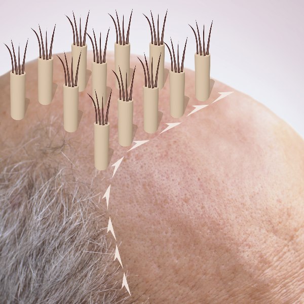 hair transplant price and cost per graft