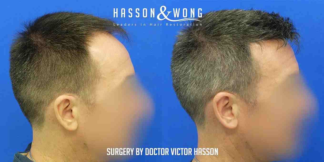 fue hair transplant right side view 5000 grafts