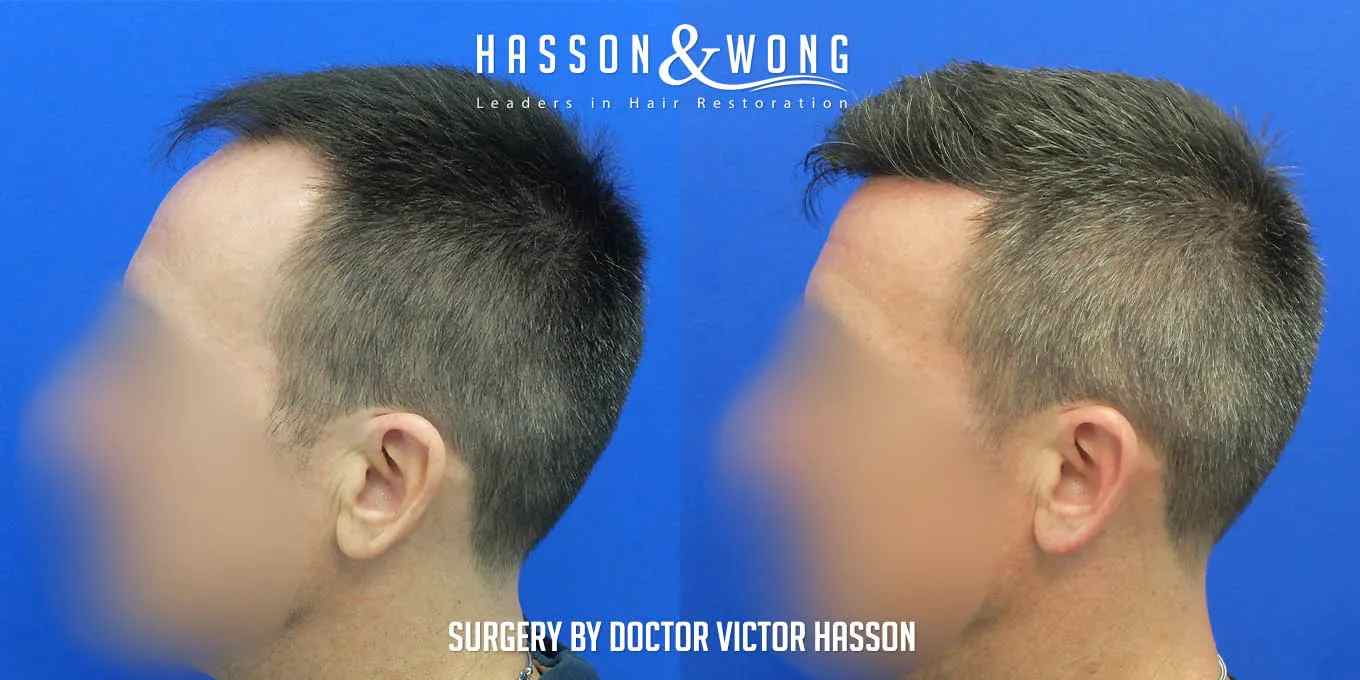 fue hair transplant 5000 grafts side view