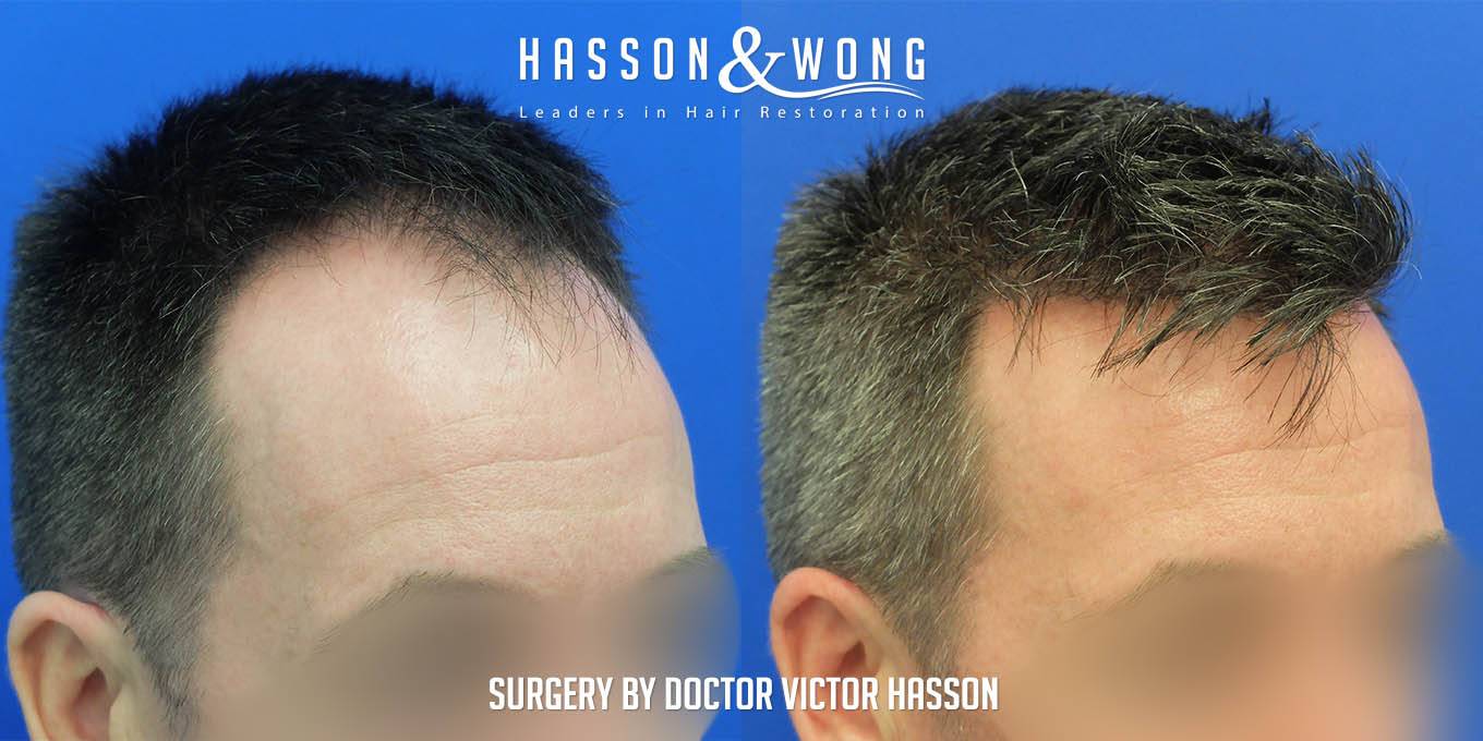 vancouver hair transplant front right temple view 5031 grafts fue 5031