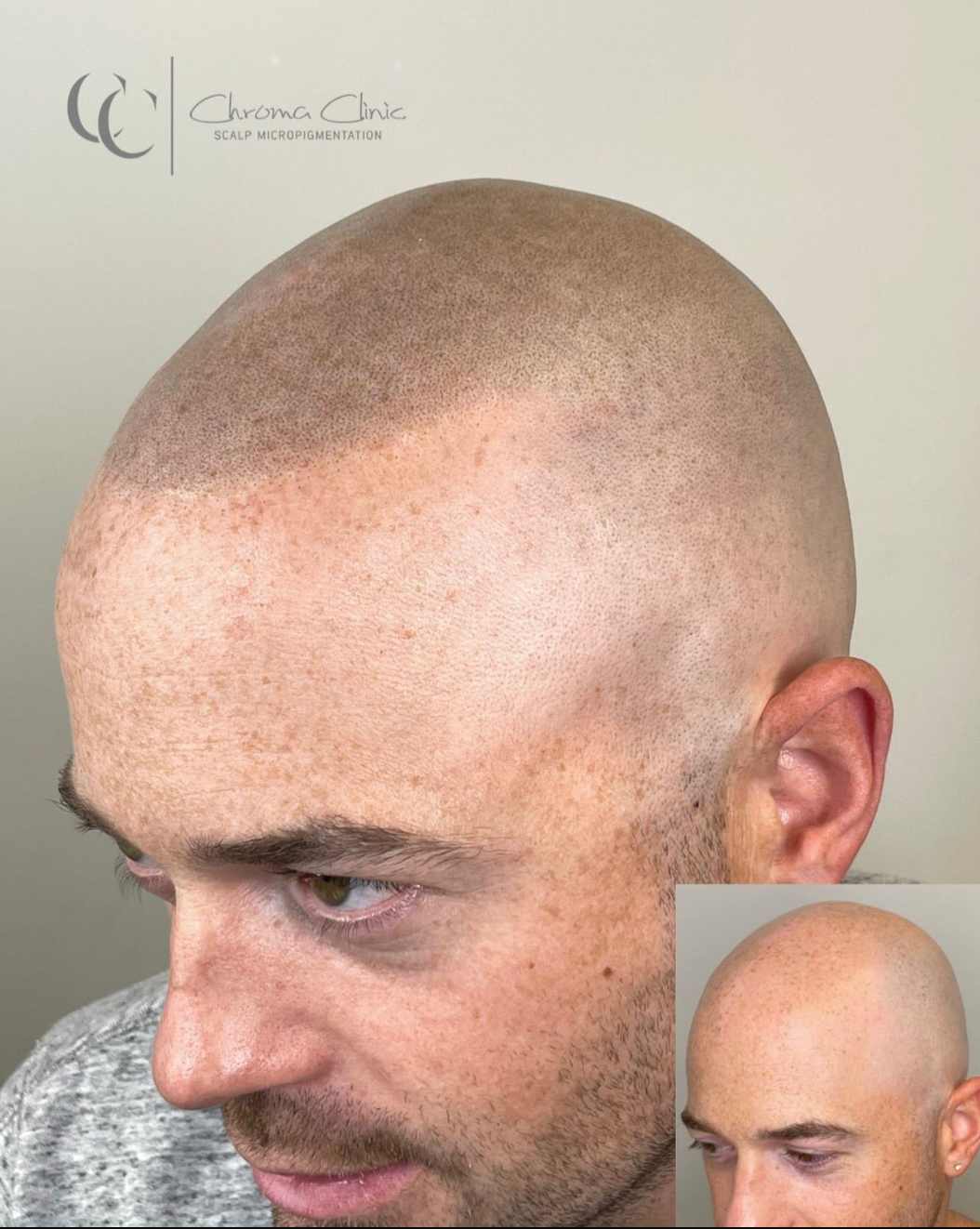 vancouver SMP before and after chroma clinic Scalp micropigmentation