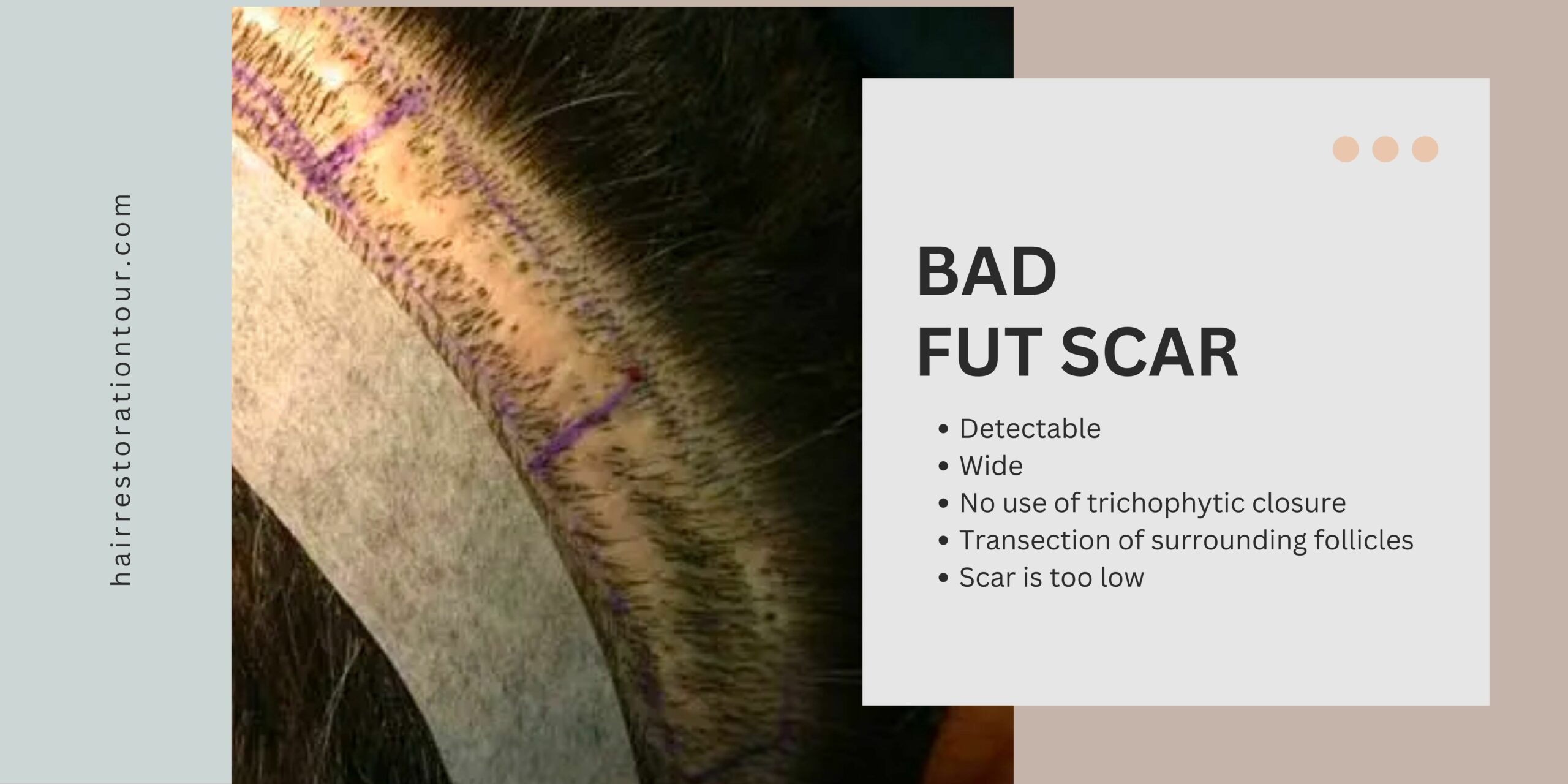 bad fut hair transplant scar