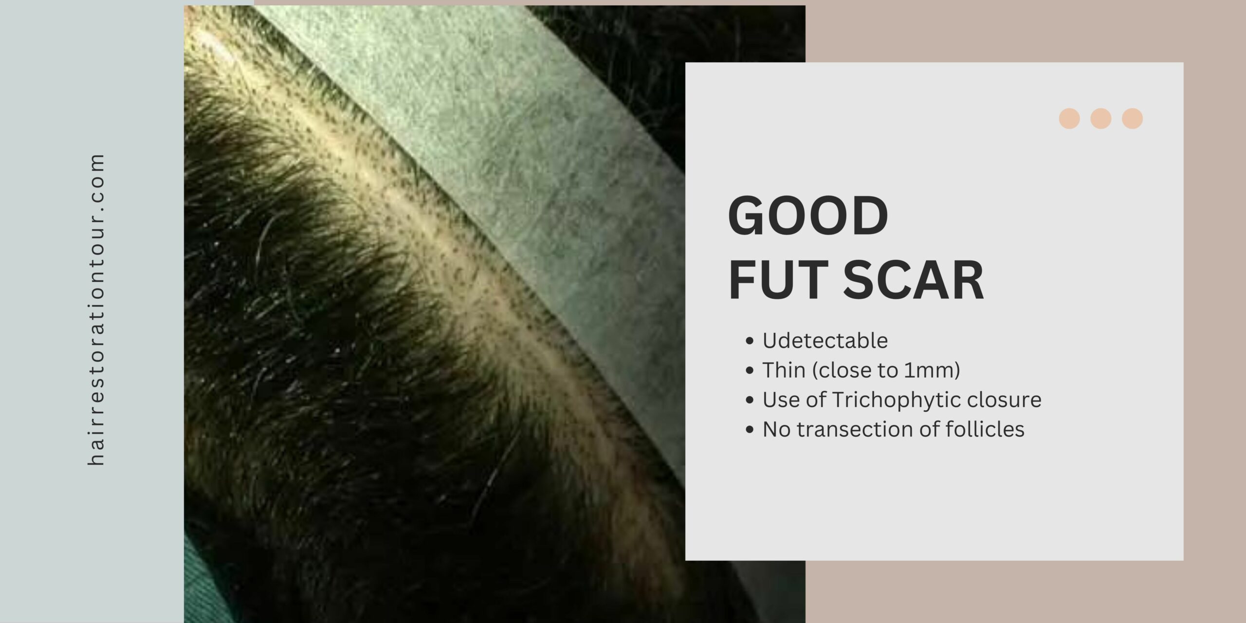 FUT hair transplant scar good