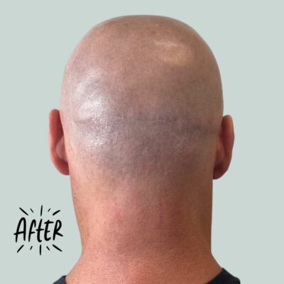 hair transplant scar SMP cover up