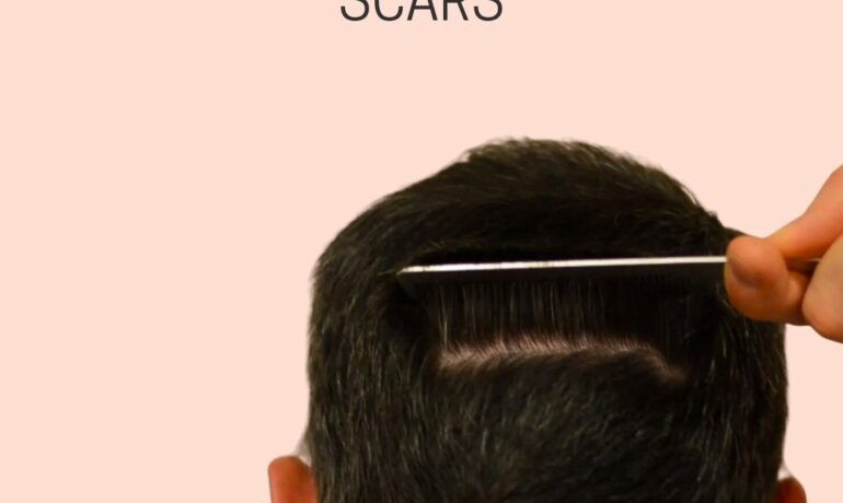 Hair Transplant Scar