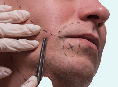 Facial Hair Transplant Surgery