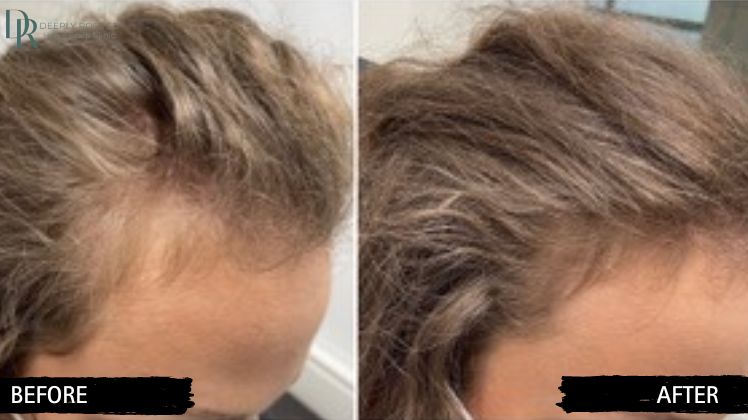 prp temple hair restoration