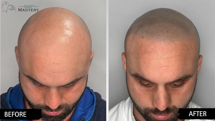 smp before and after of Seattle patient full head restoration